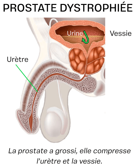 prostate dystrophiee